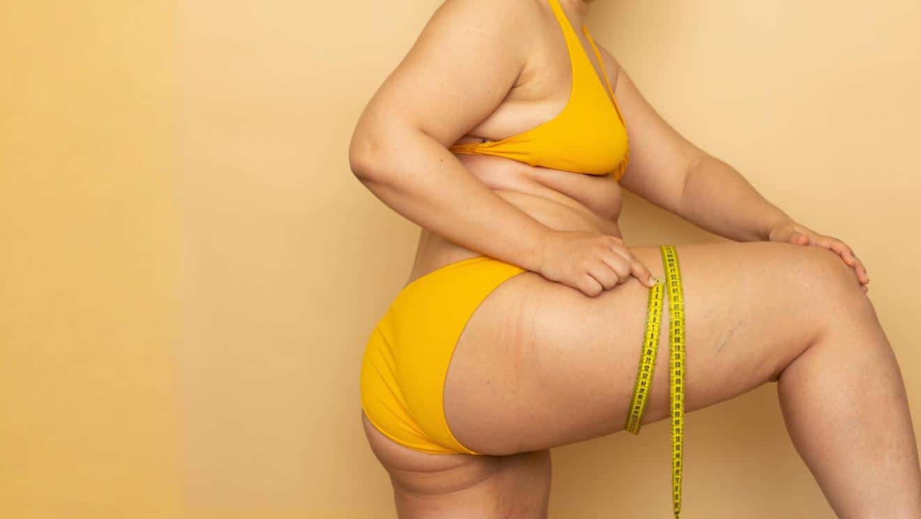 Lipedema