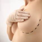 mamoplastia de aumento