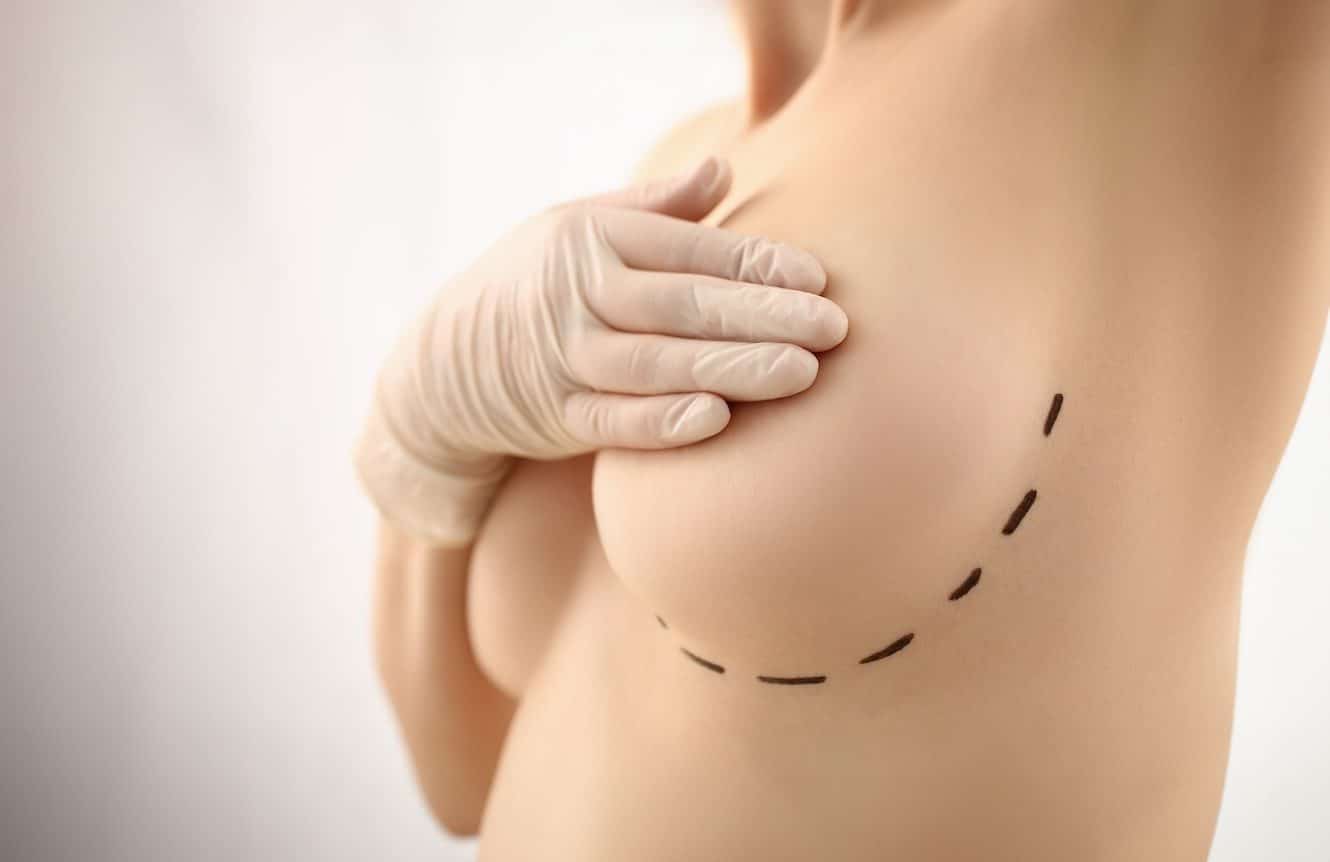 Mamoplastia de aumento e1749079882616