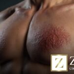 Ginecomastia grau 3: entenda os riscos e opções de tratamento eficazes