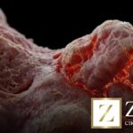 Inflamação causada por PMMA: entenda os riscos e como agir rápido