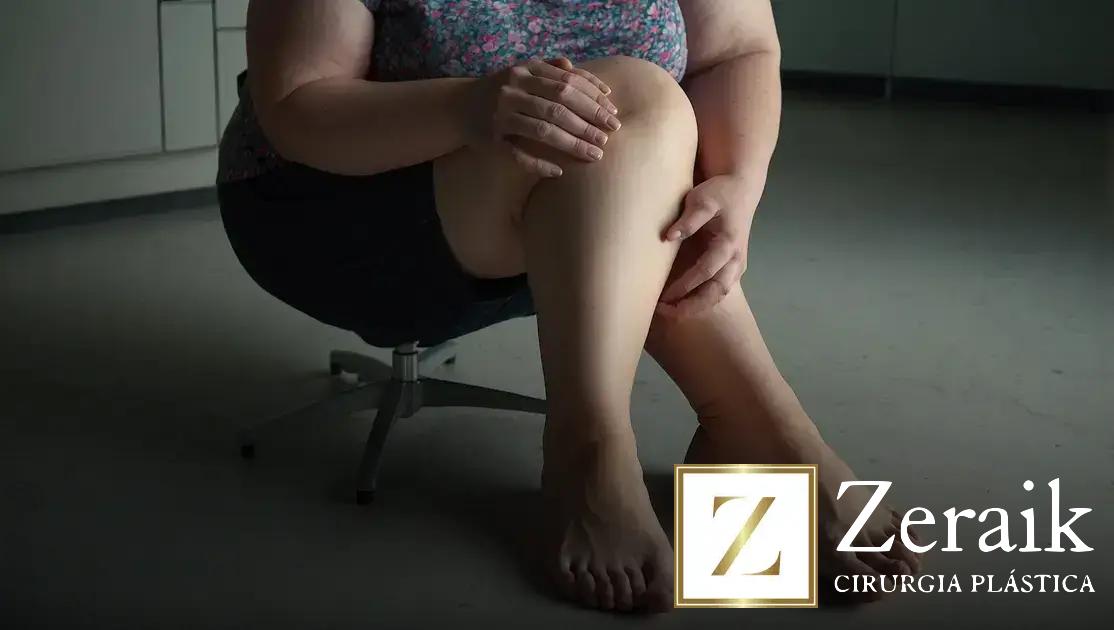 Lipedema e obesidade: entenda as diferenças e como lidar melhor
