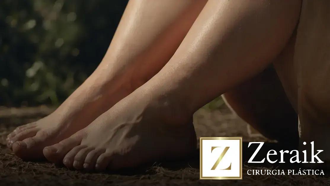 Sintomas do lipedema: como identificar os sinais que nem todo mundo conhece