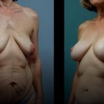 Qual a durabilidade da abdominoplastia? descubra o que esperar do resultado